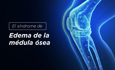 ¿Sabes qué es el síndrome de edema de la médula ósea?